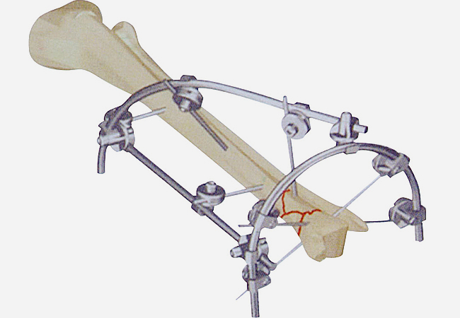 Ⅳ型1號(hào) 脛骨遠(yuǎn)端骨折