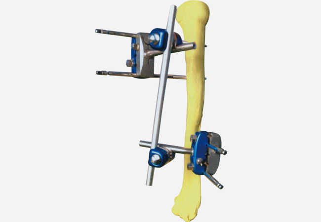  Ⅳ型2號(hào) 肱骨支架